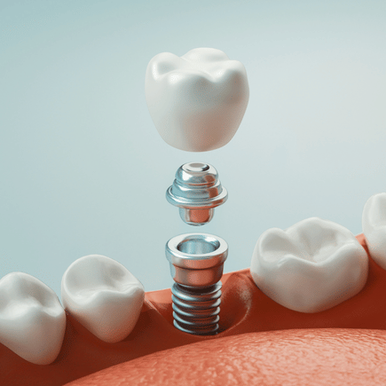 thumb1 dental implants